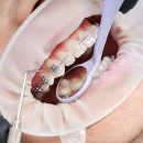 Dentist attaching metal braces to patient teeth. Close up of orthodontist using cofferdam and dental instruments while placing orthodontic brackets on patient teeth. Concept of stomatology, dentistry and orthodontic treatment.
